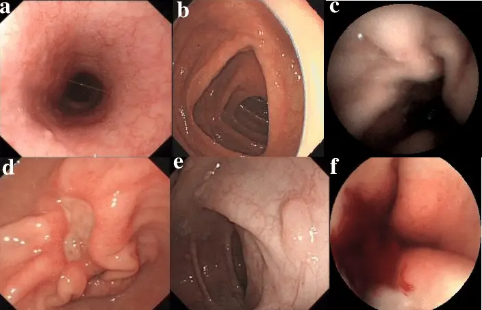 GI endoscopic imaging