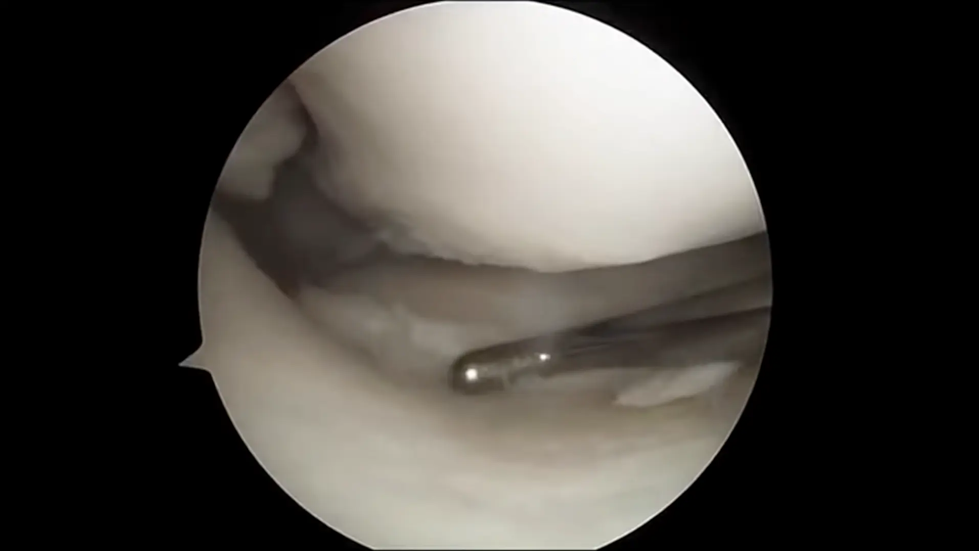 Laparoscopy procedure view